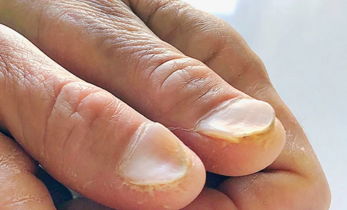 Calcipotriol and Nail Psoriasis: Treatment Options and Considerations