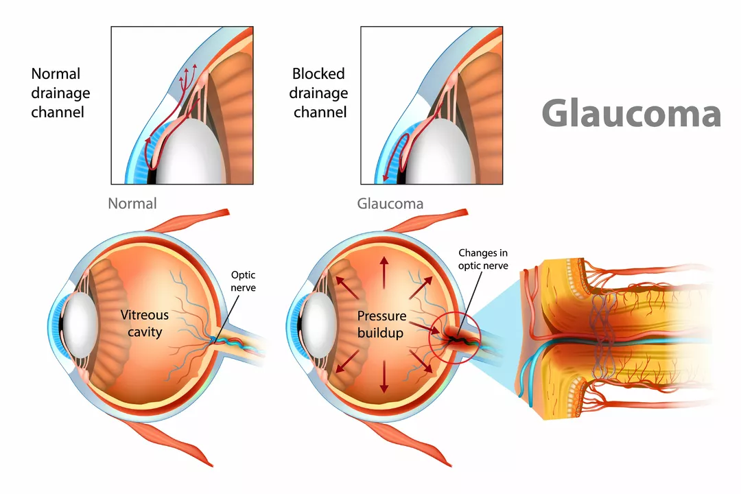 How Latanoprost Affects Your Daily Life: Tips for Managing Glaucoma